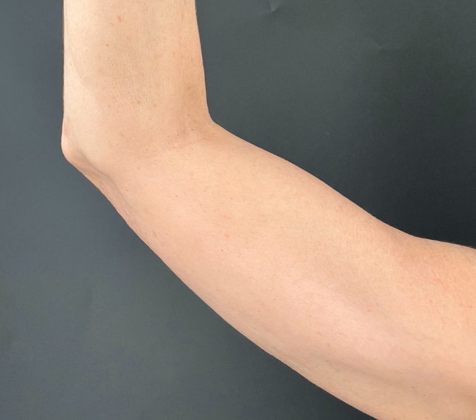 sofwave-arms-Aestheticare-Medspa-after-p94