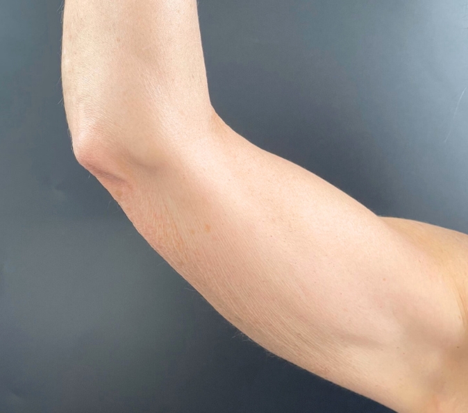 sofwave-arms-Aestheticare-Medspa-before-p93