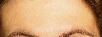 RR_Botox_beforeafter4-After