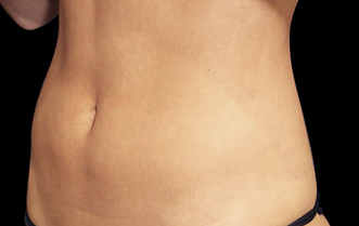 RR_emsculpt_beforeafter4-After