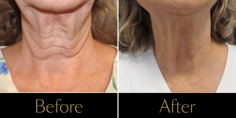 Rakus-Exilis-Gallery-neck