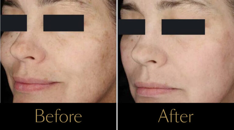 rakus-ipl-beforeafter