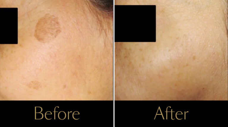 rakus-ipl-beforeafter2