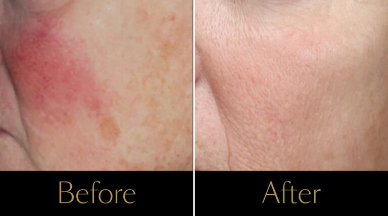 rakus-ipl-beforeafter3