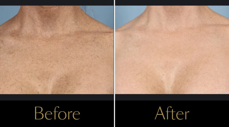 rakus-ipl-beforeafter4