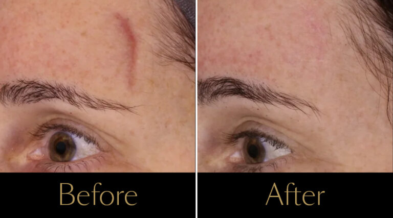 rakus-ipl-beforeafter5