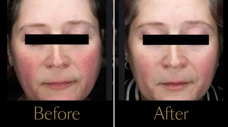 rakus-ipl-beforeafter6