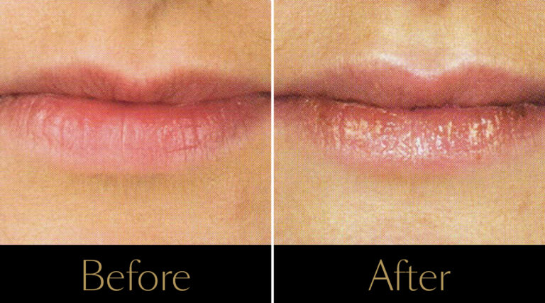 rakus-lipinjections-gallery-2