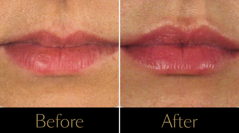 rakus-lipinjections-gallery-3