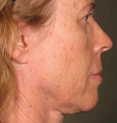 rakus-ultherapy-prime-ba-new