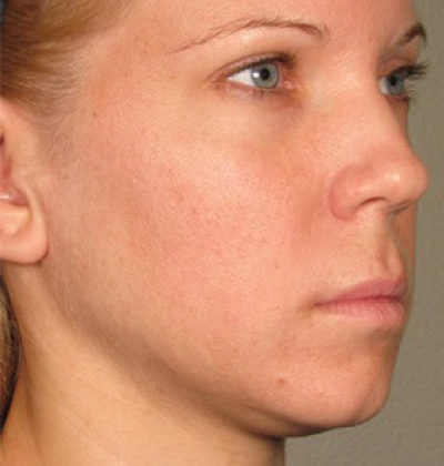 rakus-ultherapy-prime-ba-new3