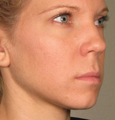 rakus-ultherapy-prime-ba-new4