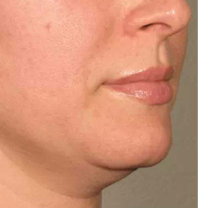 rakus-ultherapy-prime-ba3