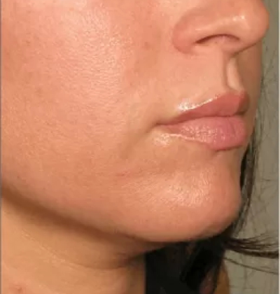 rakus-ultherapy-prime-ba4