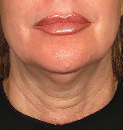 rakus-ultherapy-prime-ba7-new