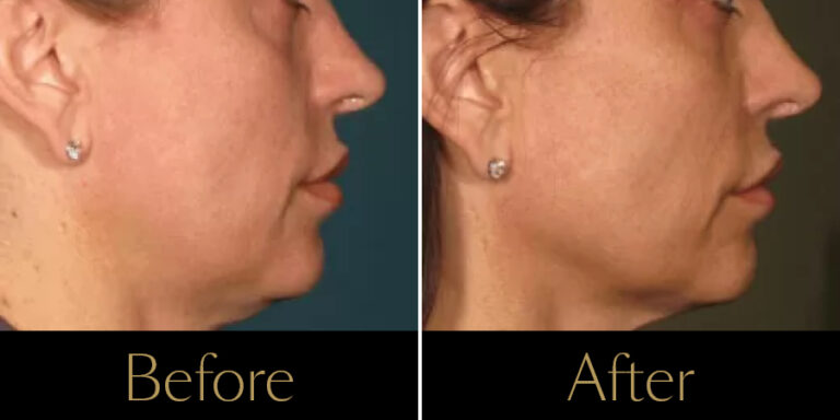 rakus-ultherapy-prime-gallery