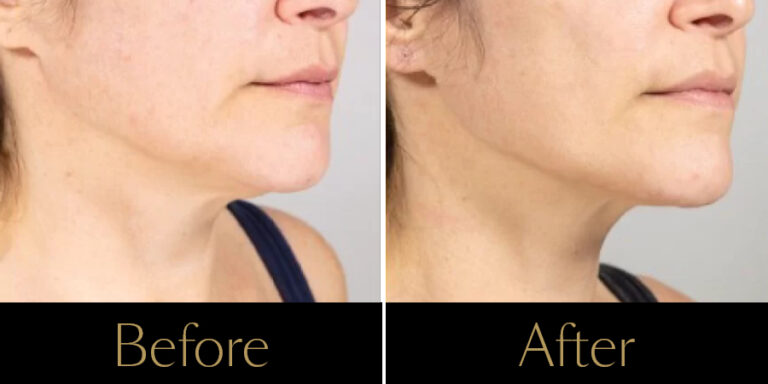 rakus-ultherapy-prime-gallery-new2