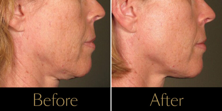 rakus-ultherapy-prime-gallery-new3