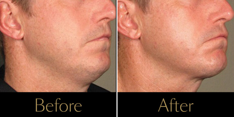 rakus-ultherapy-prime-gallery-new4