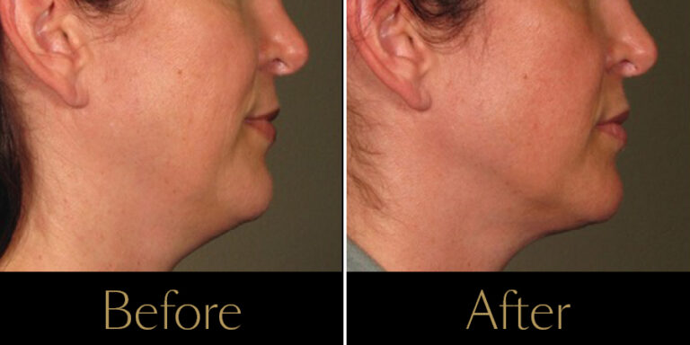 rakus-ultherapy-prime-gallery-new5