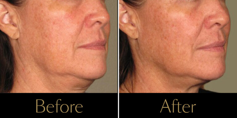 rakus-ultherapy-prime-gallery-new6