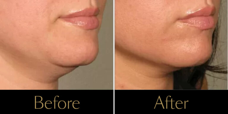 rakus-ultherapy-prime-gallery2