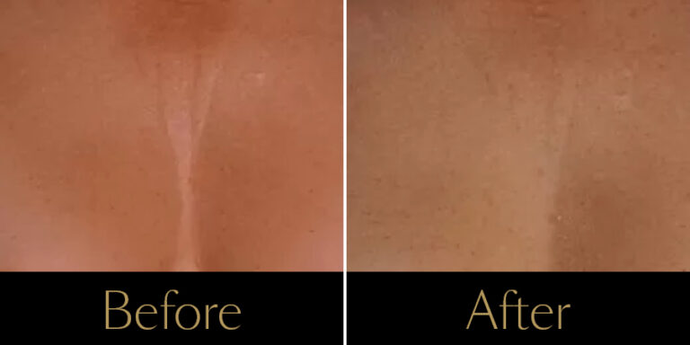 rakus-ultherapy-prime-gallery3