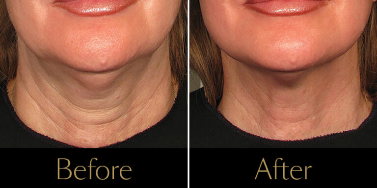 rakus-ultherapy-prime-gallery4