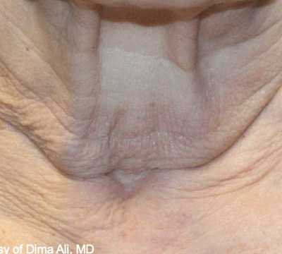 rakus-ultraclear-beforeafter-neck