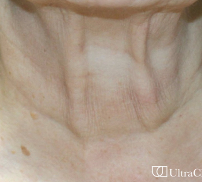 rakus-ultraclear-beforeafter-neck2