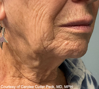 rakus-ultraclear-beforeafter