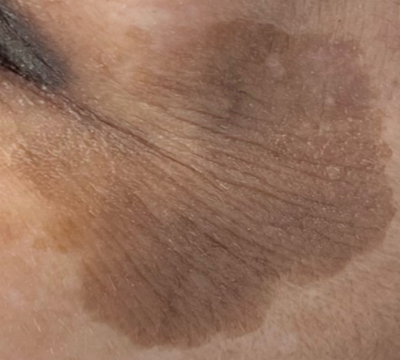 rakus-ultraclear-beforeafter10