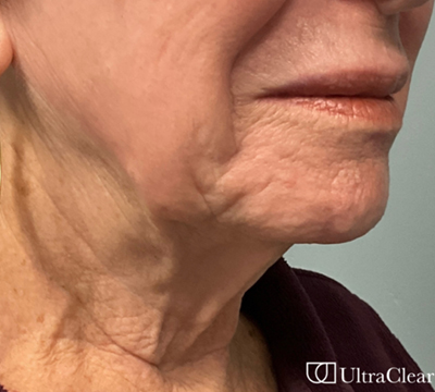 rakus-ultraclear-beforeafter2