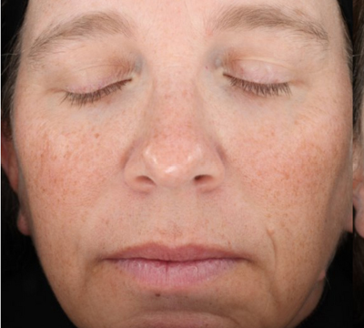 rakus-ultraclear-beforeafter6