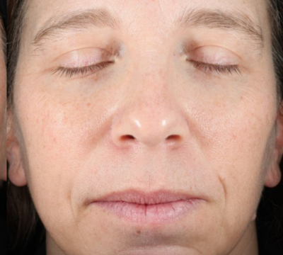 rakus-ultraclear-beforeafter7