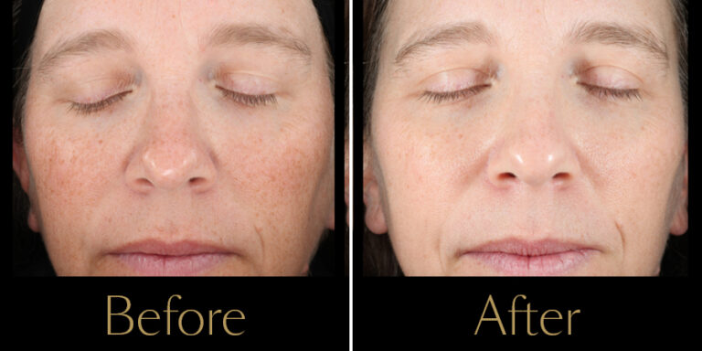 rakus-ultraclear-gallery