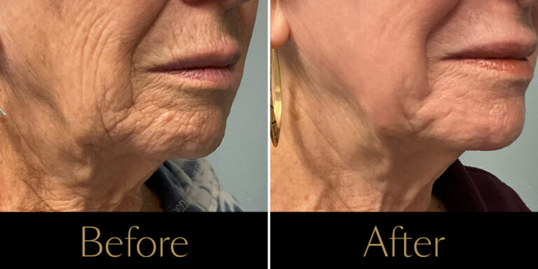 rakus-ultraclear-gallery2