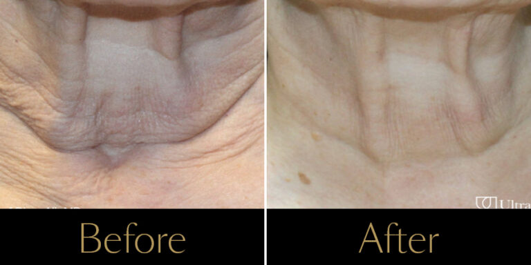 rakus-ultraclear-gallery5