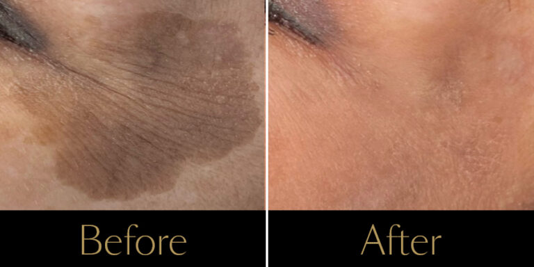 rakus-ultraclear-gallery6