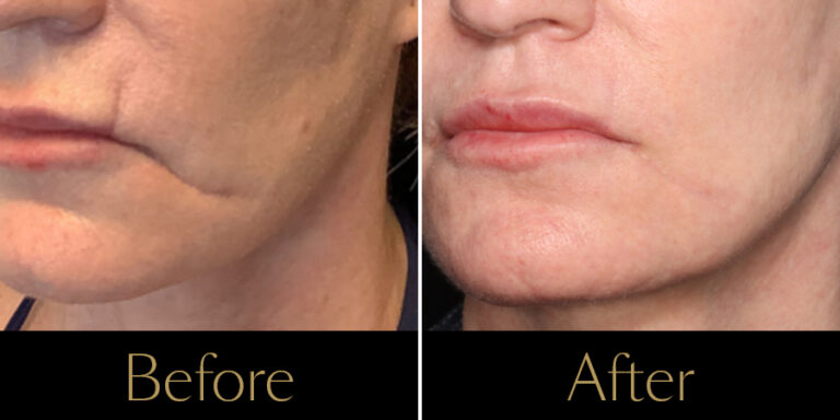 rakus-ultraclear-gallery7