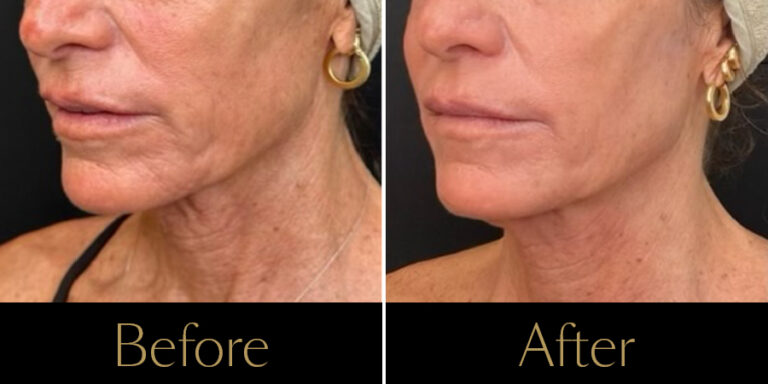 rakus-ultraclear-gallery8