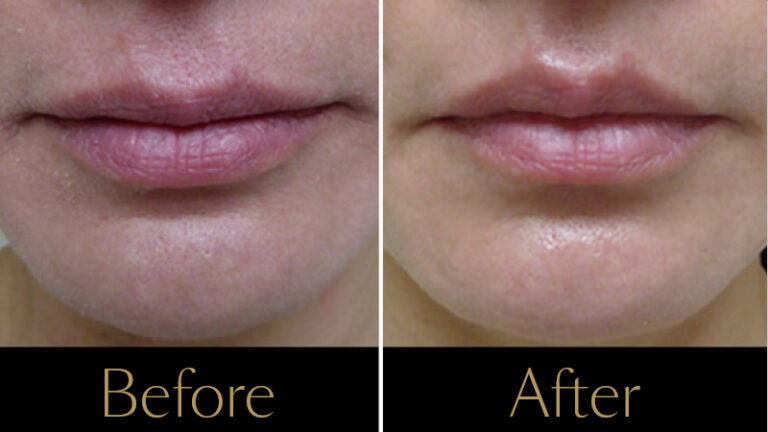 thermage-lip-example